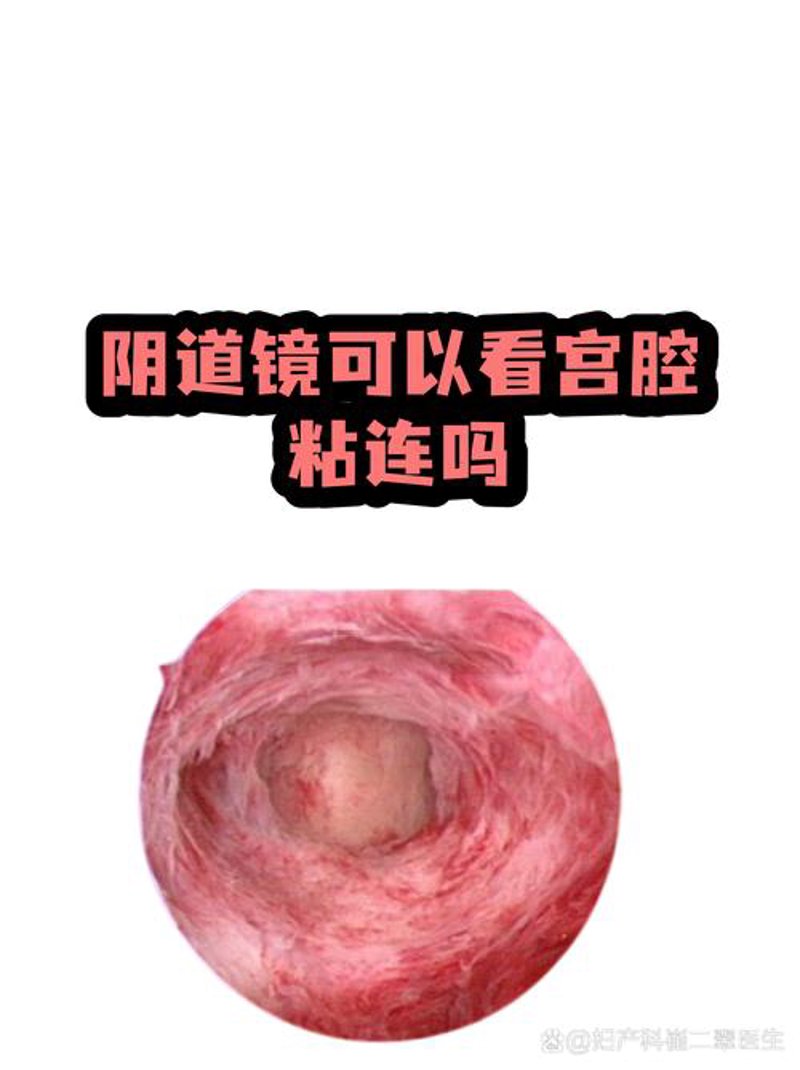 妇科检查